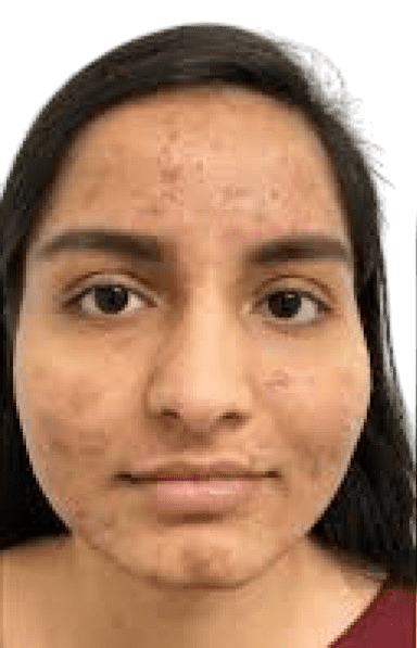 טיפולי אסתטיקה לא-כירורגית עיצוב הפנים בצורה מדויקת.2.עם דוקטור אלי לוי לפני טיפול