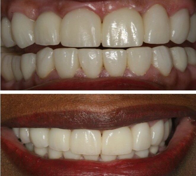 אחרי השתלת שיניים